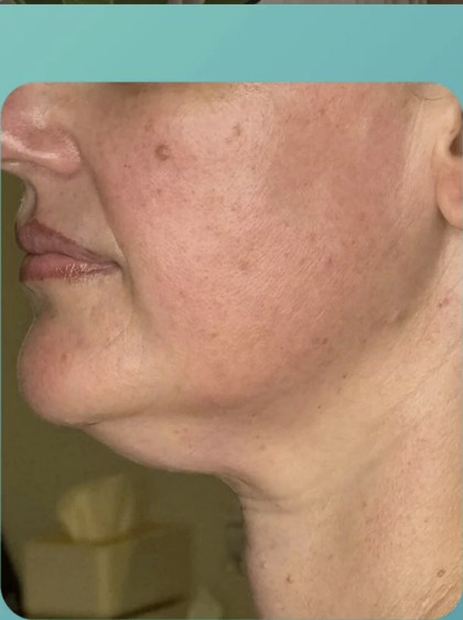 After HIFU treatment - result 1