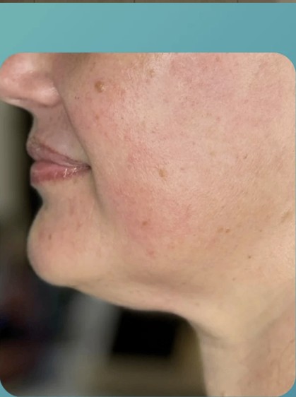 Before HIFU treatment - result 1