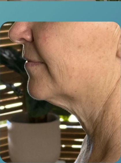 Before HIFU treatment - result 2