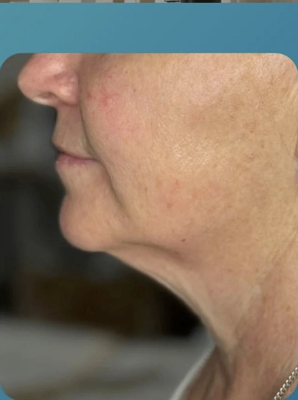 After HIFU treatment - result 2