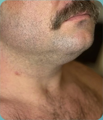 Before HIFU treatment - result 3