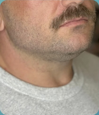 After HIFU treatment - result 3