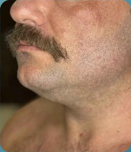 Before HIFU treatment - result 4