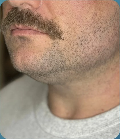 After HIFU treatment - result 4