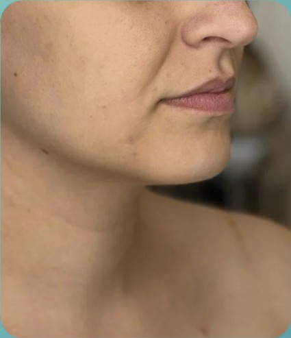 Before HIFU treatment - result 5
