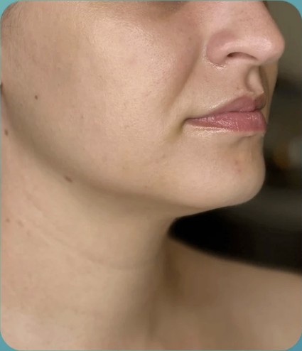 After HIFU treatment - result 5