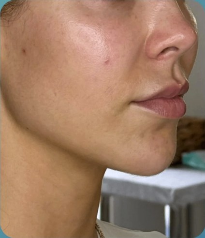 Before HIFU treatment - result 6