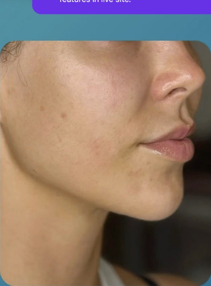 After HIFU treatment - result 6