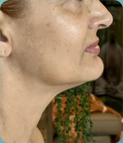 Before HIFU treatment - result 7