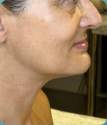 After HIFU treatment - result 7