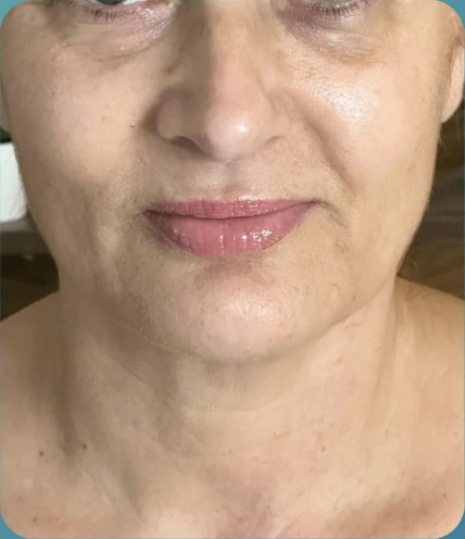 Before HIFU treatment - result 8