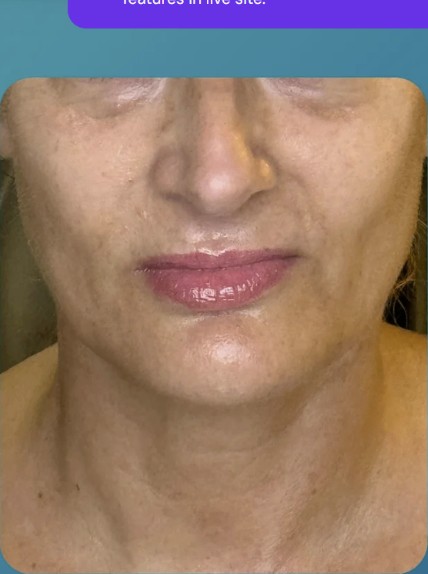 After HIFU treatment - result 8