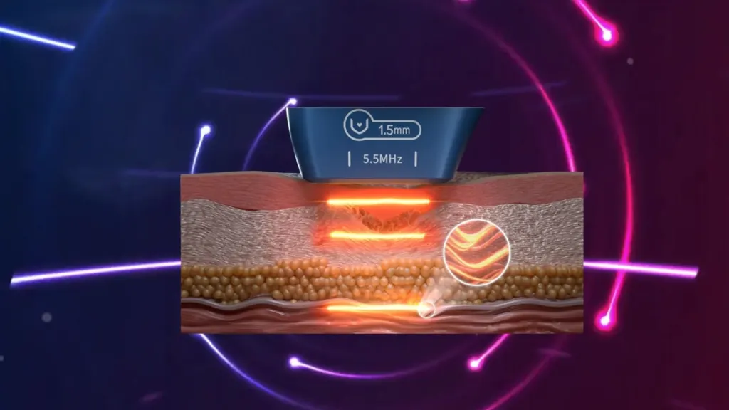 Close-up of the UltraTherapy 15D HIFU machine using MPT micro-pulse delivery for faster, more comfortable skin tightening treatments.